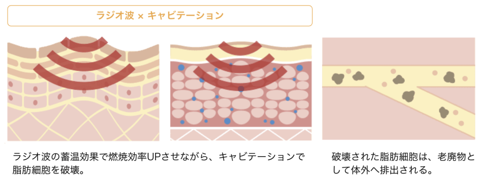 ラジオ波の蓄温効果で燃焼効率を高めながら、キャビテーションで脂肪細胞を破壊します。破壊された脂肪細胞は老廃物として体外へ排出されます。