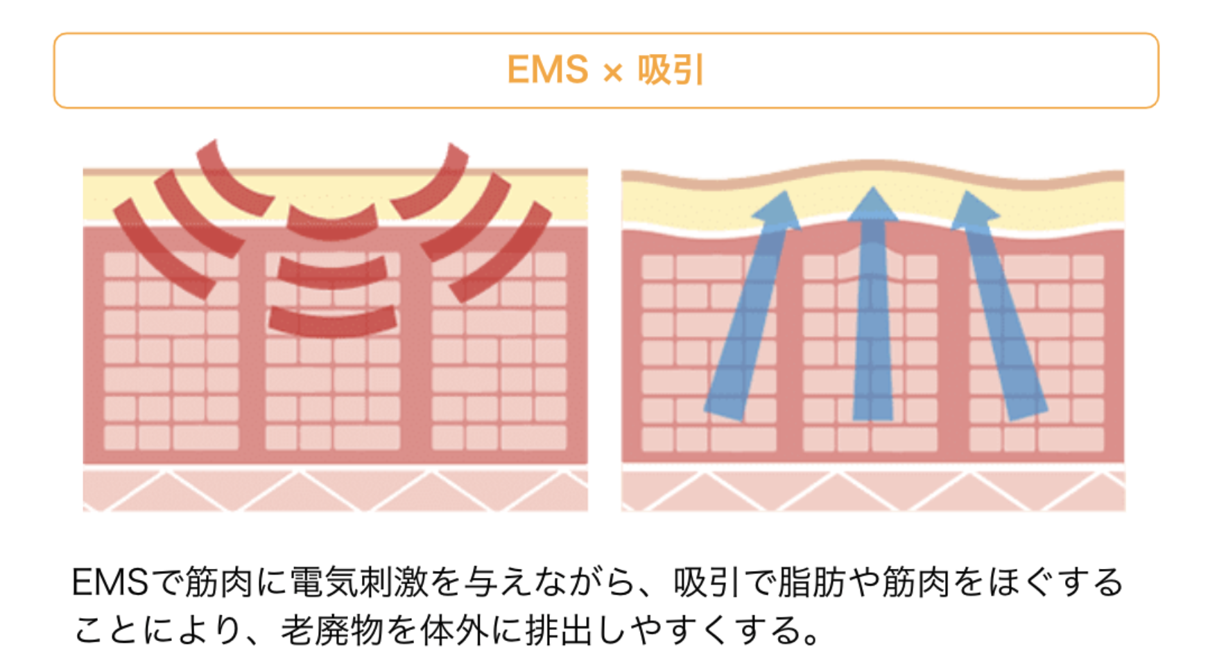 EMSで筋肉に電気刺激を与えながら、吸引で脂肪や筋肉をほぐすことにより、老廃物を体外に排出しやすくする。