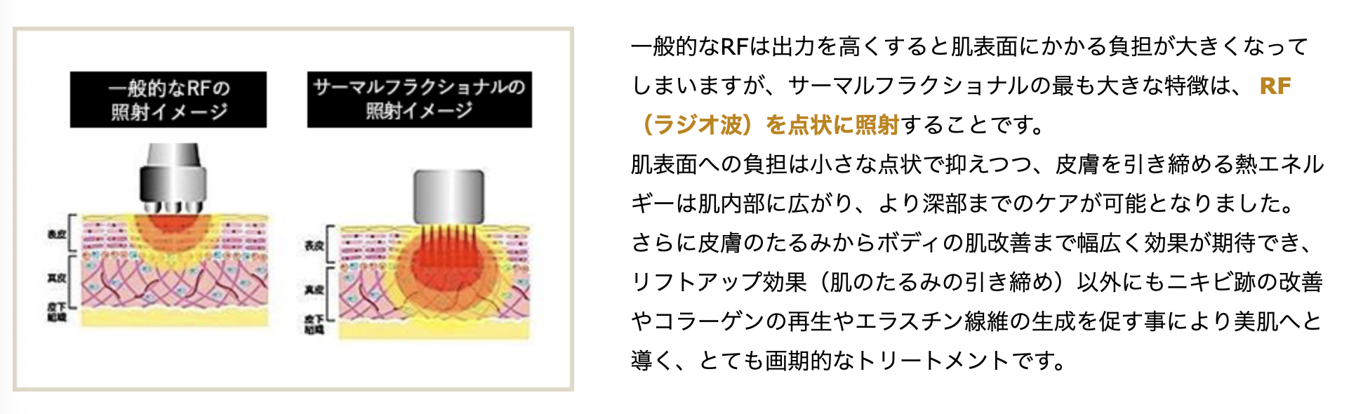 サーマルフラクショナルと一般的なラジオ波との違い