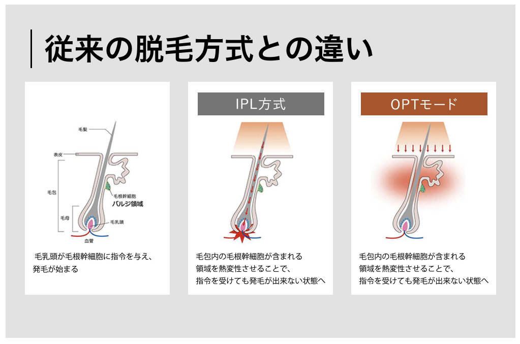 従来の脱毛方式との違い